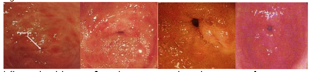 Figure 1a NG. Endoscopy of nodular gastritis (in a 75 years old man with non-specific dyspepsia and heartburn) before and after successful H. pylori treatment. Note that treatment takes months to undergo visual effect of healing.