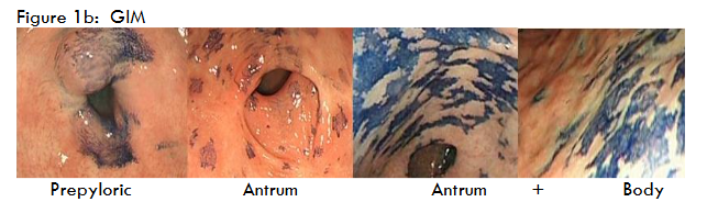 Figure 1b GIM. Chromendoscopy using methylene blue of GIM: GM in prepyloric region, of antrum, of antrum and body of stomach. Lower panel shows chromoendoscopy 6 months after endoscopic mucosal resection using Lam’s technique; there was no recurrence, as confirmed by biopsy (total 8) and histology examination.