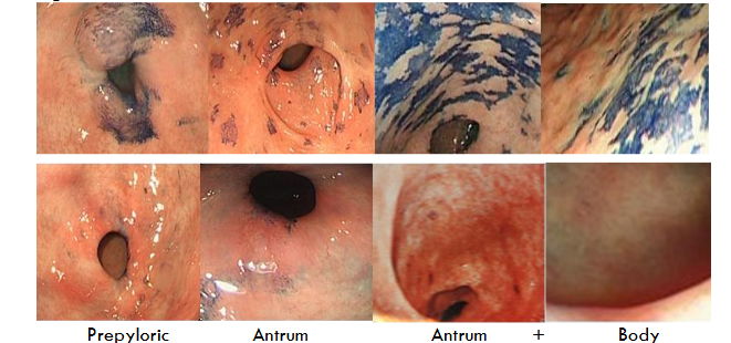 Figure 3. Chromoendoscopy before and after endoscopic mucosal resection using Lam’s technique. Upper panel: chromendoscopy using methylene blue of GIM: GM in prepyloric region, of antrum, of antrum and body of stomach. Lower panel shows chromoendoscopy 6 months after endoscopic mucosal resection using Lam’s technique; there was no recurrence, as confirmed by biopsy (total 8) and histology examination.