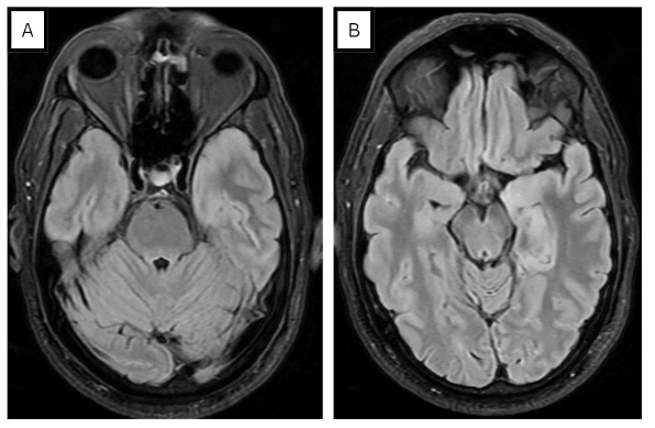 Figure 1. MRI brain images in a 55-year-old male with herpes simplex virus encephalitis. Fluid-attenuated inversion recovery (FLAIR) image showing T2 hyperintensity within the left mesial temporal lobe associated with mild gyral expansion and sulcal effacement (A & B).