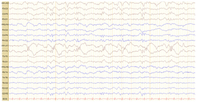 Figure 2. EEG recording in our patient with acute herpes simplex virus encephalitis: An 18-channel EEG demonstrate sub-continuous periodic lateralized discharges (PLDs) over the left hemisphere, along with bilateral independent periodic discharges (BIPDs) over a background activity that shows generalized continuous mild-moderate slowing.