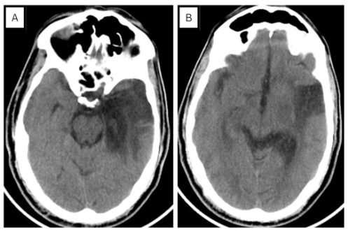 Figure 3. Non-contrast CT head 8 months post HSV encephalitis. (A) Large left temporal hypodense area measuring about 6.8x4 cm. (B) Involutional brain changes in form of prominent Sylvian fissure, extra-axial CSF spaces and ventricular system.