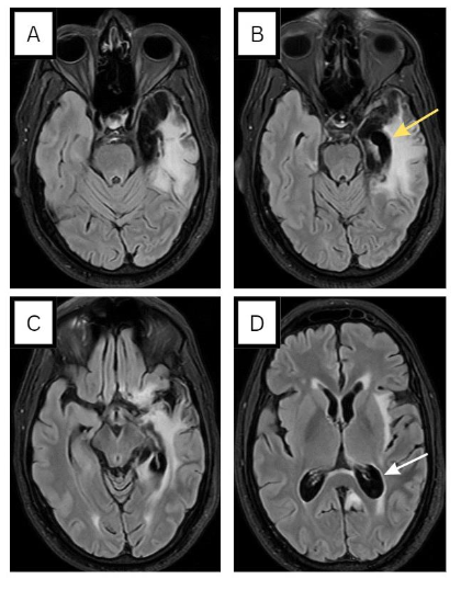 Figure 4. FLAIR MRI brain 8 months post-HSV encephalitis: left temporal cortical/subcortical areas of encephalomalacia (A, B, C). Gliosis, evidenced by hyperintense T2/FLAIR signal, encompasses these regions, including the insula (D), resulting in cortical sulci widening and ex vacuo dilatation of the trigone (white arrow) and temporal horn of the left lateral ventricle (yellow arrow).