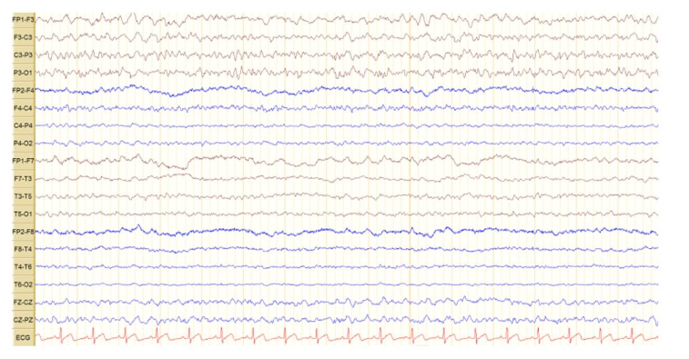 Figure 5. EEG showing non-convulsive status in second admission. 18-channel awake EEG Showing continuous focal epileptiform discharges over the left central parietal region at 2-3 Hz that shows itself as quasi periodic discharges during a background activity of continuous moderate slowing over the same region with intermittent generalized moderate slowing, a pattern reflecting focal non-convulsive status epilepticus.