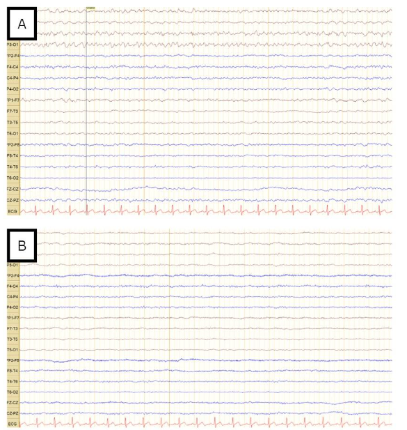 Figure 6. Follow-up 18-channel EEG conducted after escalation of antiepileptic therapy. (A) shows EEG recording 1 day after levetiracetam increased to 1500mg BID. It shows occasional focal epileptiform discharges over the left fronto-central region, with no evidence for a non-convulsive status epilepticus. Follow up the next day, after starting lacosamide 200mg BID (B) shows no epileptiform discharges over a background activity that shows intermittent focal mild slowing over the right frontocentral region.