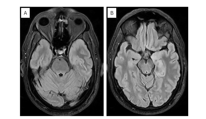 Figure 1. MRI brain images in a 55-year-old male with herpes simplex virus encephalitis. Fluid-attenuated inversion recovery (FLAIR) image showing T2 hyperintensity within the left mesial temporal lobe associated with mild gyral expansion and sulcal effacement.