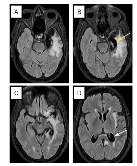 Figure 4. FLAIR MRI brain 8 months post-HSV encephalitis: left temporal cortical/subcortical areas of encephalomalacia (A, B, C). Gliosis, evidenced by hyperintense T2/FLAIR signal, encompasses these regions, including the insula (D), resulting in cortical sulci widening and ex vacuo dilatation of the trigone (white arrow) and temporal horn of the left lateral ventricle (yellow arrow).
