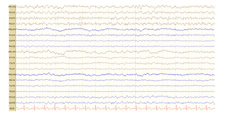Figure 5. EEG showing non-convulsive status in second admission. 18-channel awake EEG Showing continuous focal epileptiform discharges over the left central parietal region at 2-3 Hz that shows itself as quasi periodic discharges during a background activity of continuous moderate slowing over the same region with intermittent generalized moderate slowing, a pattern reflecting focal non-convulsive status epilepticus.