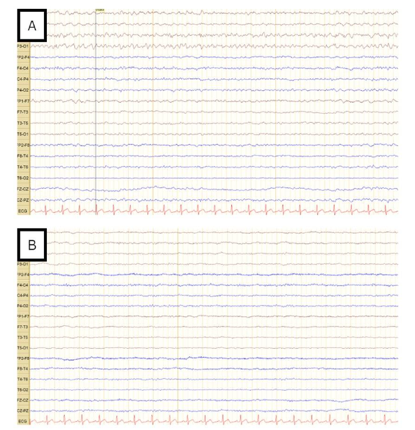 Figure 6. Follow-up 18-channel EEG conducted after escalation of antiepileptic therapy. (A) shows EEG recording 1 day after levetiracetam increased to 1500mg BID. It shows occasional focal epileptiform discharges over the left fronto-central region, with no evidence for a non-convulsive status epilepticus. Follow up the next day, after starting lacosamide 200mg BID (B) shows no epileptiform discharges over a background activity that shows intermittent focal mild slowing over the right frontocentral region.