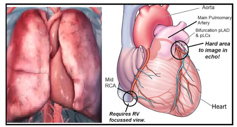 Image (left) shows how the lungs, which block ultrasonic transmissions, cover the far medial and lateral aspects of the heart, which, as shown in image (right), include locations of key coronary targets, such as the mid RCA, prox LAD, and prox to mid LCx.