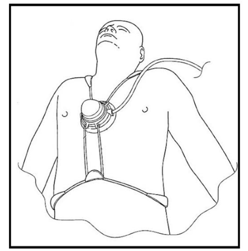 The TIMI3 LFUS (27 kHz) STEMI Reperfusion Device. Image taken from US patent application 2002072691 A1 (public domain).