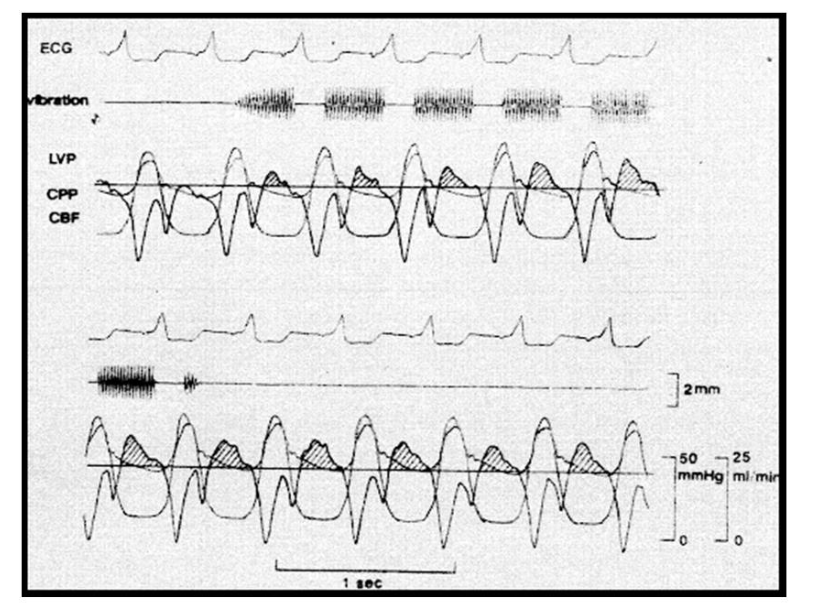 Figure 10: Image (top) Shows the responses of LV Pressure (LVP), Coronary Perfusion Pressure (CPP), and Coronary Blood Flow (CBF - thick solid line) following application of vibration to the left ventricle with regional ischemia. Diastolic CBF increases due to vibration input, and this increase lasted for several beats after cessation of vibration. Image (bottom) shows a close-up superimposition of the effects of vibration (solid lines), versus no vibration (dashed lines), including enhanced CBF, increased LVP fall (-dp/dt), and a fairly constant CPP regardless of vibration. Images taken with permission from Koiwa et al. [91], Effects of Diastolic Vibration on Coronary Circulation, Japanese Journal of Medicine, Vol 32, (1994), Issue 3, pg. 180 - 187.