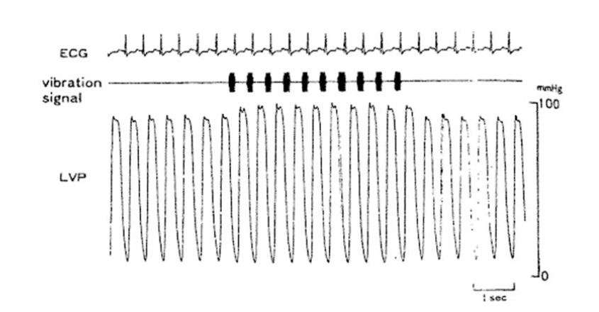 Figure 11: Tracings of LV Pressure (LVP), ECG and dtLFV signal. Note characteristic instant decrease in LV diastolic pressures and increase in LVP systolic pressures during application of dtLFV, which indicates an increase in stroke volume, secondary to improved diastolic relaxation with increased LV filling, by the Frank-Starling mechanism. Image taken with permission from Koiwa et. a [92], (1992), Diastolic Vibration Improves Systolic Function in Cases of Incomplete Relaxation Circulation, Vol 86 No. 6 pp 1955 - 1964.