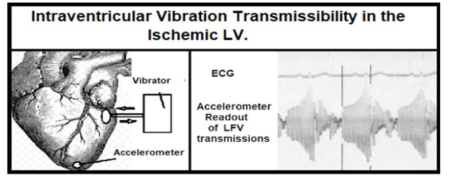 Figure 12: Shows how an LFV input applied to the LV with induced regional ischemia readily transmits along the epi-myocardium, thereby enabling a therapeutic "shaking" response to a greater percentage of the coronary tree. Image taken from Elsevier Open Access. Smith D et. al. [97], Mechanical vibration transmission characteristics of the left ventricle implication with regard to auscultation and phonocardiography. J Am Coll Cardiol 1984, 4(3):517 521.
