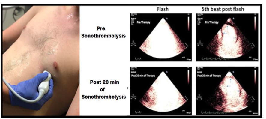 Image (left) shows the placement of an echo transducer to the apical window. Image (right) shows echocardiographic images pre- and post-HFUS sonothrombolysis in a pre-PPCI STEMI victim showing successful reperfusion. Image taken from JACC, Vol 67, Issue 21, 31 May 2016, Page 2506-2515 [Open Access].