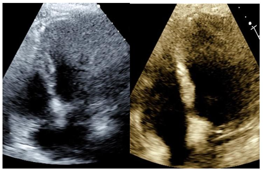 Image (left) shows an initial attempt at visualizing the apical four-chambered view on a technically difficult patient. Image (right) shows the best possible corrected image, which is only marginally better. Image taken with permission from the False Creek Diagnostic Center.