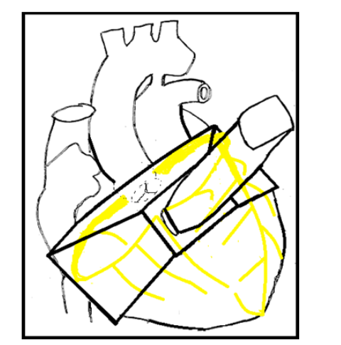 A diagrammatic representation of a strategically positioned 3D HFUS sonothrombolysis imaging pyramid, shown to encompass the proximal to mid aspects of the coronary tree.