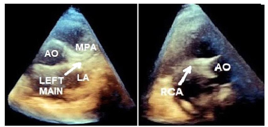 Image (left) shows a 3D HFUS imaging pyramid, capturing the AOrtic root (AO) where the Left Main coronary artery and leftward aspect of the MPA /LA, home of the prox LAD/LCx, can be seen. Image (right) shows a 3D imaging pyramid, including the location of the proximal to mid RCA (shown by arrow). Image taken with permission from the archives of the False Creek Diagnostic Center.