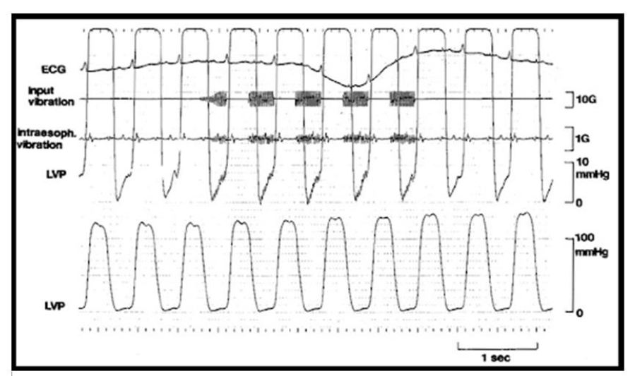 Figure 8: The application of dtLFV (50 Hz, 2 mm amplitude) penetrates from a human left precordial rib-space to the heart, measured from an intra-esophageal accelerometer and LV pressure transducer. Image taken with permission from Koiwa et. Al. [86], Modification of Human Left Ventricular Relaxation by Small Amplitude, Phase Controlled Vibration to the Chest Wall, Circulation 1997 (95): 156 - 162.
