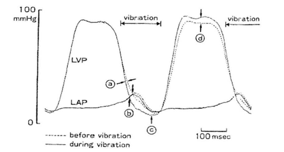 Figure 9: Superimposed tracings of LV and LA Pressure (LVP, LAP) without vibration (dashed lines) and at the first application of dtLFV (solid lines) in a canine model. Diastolic Timed Low Frequency Vibration accelerated LV relaxation (point a), and caused a decrease in minimum LV diastolic pressure (point c). A marked increase in systolic pressure (signifying a sudden enhancement in stroke volume, following the first application of dtLFV) is easily seen (point d). Image taken with permission from Koiwa et. al. [87], (1992) Circulation Vol 86 No. 6 pp 1955 - 1964.