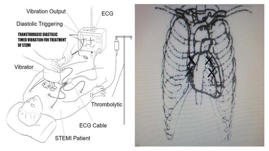 Figure (Left) A diagrammatic representation of a proposed dtLFV massager (50 Hz, 4 mm stroke) operable to enhance thrombolytic drug delivery and effectiveness to assist STEMI reperfusion. Figure (Right) A diagram of the heart and coronary arteries underlying the ribcage with suggested contact node placement sites shown by X, to generally overly the RCA and LAD.
