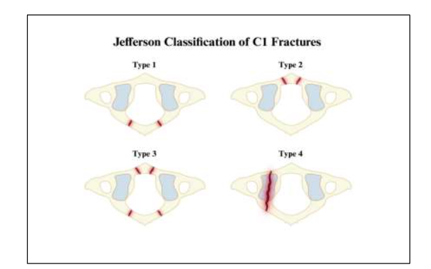 Figure 1: Jefferson Classification System for C1 Fractures. Jefferson Variants include fractures of the bilateral posterior arches (Type 1), bilateral anterior arches (Type 2), bilateral anterior and posterior arches (Type 3), and lateral mass (Type IV).