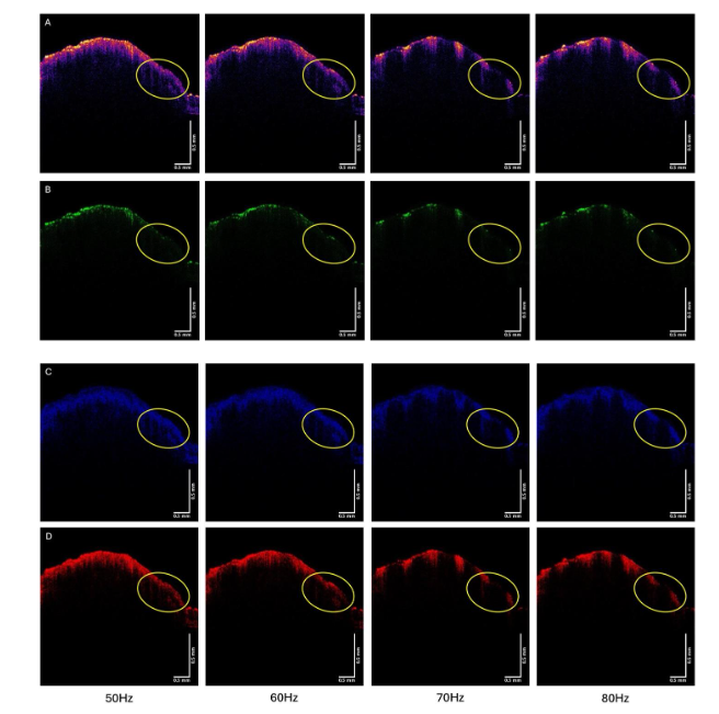 Figure 5. OCT images of SCC from Patient 29 from Figure 4 vibrated at 50, 60, 70 and 80 Hz for color-coded (A), green (B), blue (C), and red (D) subchannels. The circled region image disappears in the green subchannel and loses intensity in the blue and red subchannels when vibrated at 70 and 80 Hz.