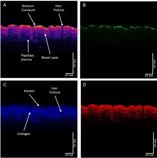 Figure 1. An OCT image of color-coded (A), green (B), blue (C), and red (D) subchannel images of normal skin. Note the arrows pointing to the hyporeflective region (1C) in normal skin consistent with the keratin intermediate filaments present in the cells of the mid epidermis. Keratin in hair in the skin is also hyporeflective as is shown in Figure 1A. The green, blue, and red subchannel images are shown in Figure 1B, C, and D.