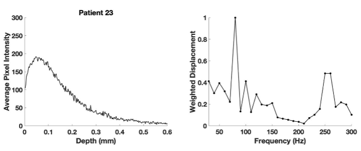 Figure 10. Average pixel intensity versus depth for color-coded image (left) and weighted displacement versus frequency (right) for the SCC shown from patient 23. Note the increased width of the pixel intensity versus depth plot compared to Figure 3. The resonant frequency peaks at 80, 130, and 250-260 Hz are indicative of a cancerous lesion.