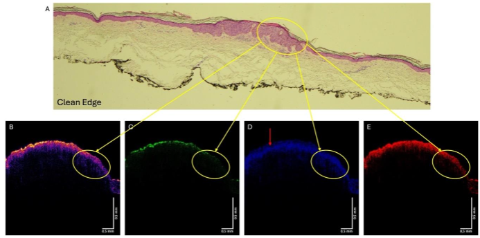 Figure 4. Histopathology (A), OCT color-coded image (B), green (C), blue (D), and red (E) subchannel images of a SCC from patient 29. Note the hyporeflective region in D (red arrow) that putatively represents microfilament keratin seen in normal epidermis is missing in D where the lesion is circled.