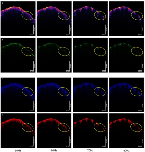 Figure 5. OCT images of SCC from Patient 29 from Figure 4 vibrated at 50, 60, 70 and 80 Hz for color-coded (A), green (B), blue (C), and red (D) subchannels. The circled region image disappears in the green subchannel and loses intensity in the blue and red subchannels when vibrated at 70 and 80 Hz.