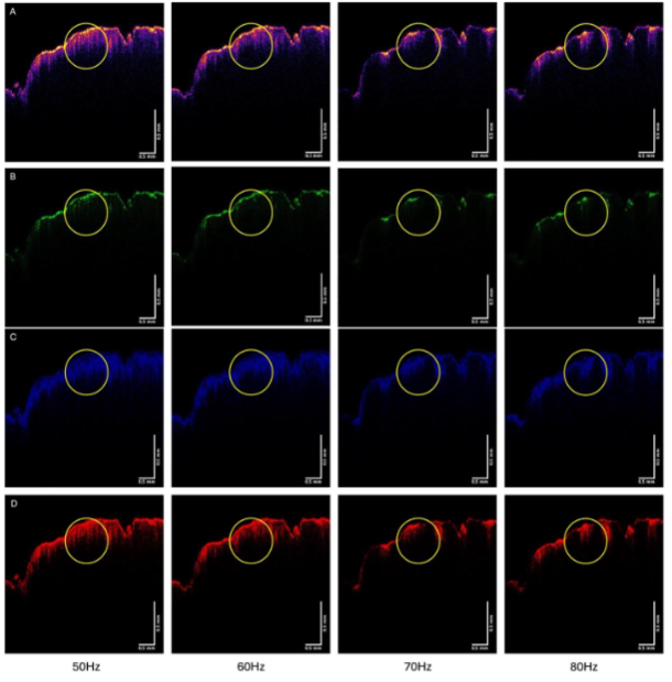 Figure 9. Color-coded OCT images of SCC during vibrations at 50, 60, 70 and 80 Hz for patient 23 (A), and green (B), blue (C), and red (D) subchannel images during vibration. Note the circled lesion appears to partially disappear in the green channel image at 70 and 80 Hz as well as other lesions that are seen in Figure 5A.