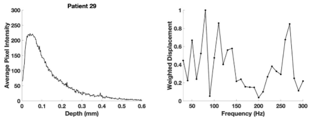 Figure 6. Pixel intensity versus depth (left) for the color-coded image and weighted displacement versus frequency (right) for the SCC from patient 29 shown in Figure 4B. The pixel intensity of the reflected light falls off with increased depth of the sample because of both Rayleigh (small particles) and Mie scattering (large particles) of the light. Note the new peaks at 80, 130, and 260 Hz are indicative of cancerous tissues.