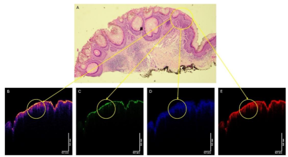 Figure 8. Histopathology of a SCC from Patient 23 (A) and color-coded OCT image (B), green (C), blue (D), and red (E) subchannel images. Note the circled region in A contains what appears to be keratin deposits. There are many lesions not circled in Figure 8A to avoid confusion.