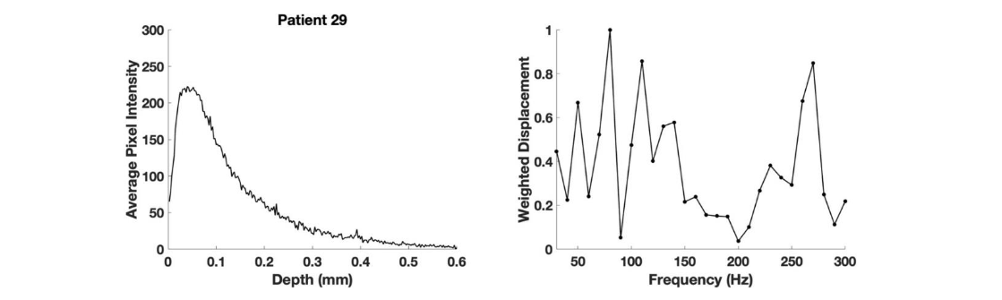 Figure 6. Pixel intensity versus depth (left) for the color-coded image and weighted displacement versus frequency (right) for the SCC from patient 29 shown in Figure 4B. The pixel intensity of the reflected light falls off with increased depth of the sample because of both Rayleigh (small particles) and Mie scattering (large particles) of the light. Note the new peaks at 80, 130, and 260 Hz are indicative of cancerous tissues.