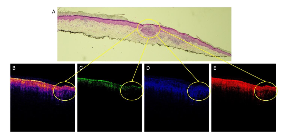 Figure 1 shows an H&E-stained histological section of a BCC (Figure 1A) as well as a typical color-coded OCT image of the same basal cell carcinoma (Figure 1B) along with the green (1C), blue (1D), and red subchannel (1E) images also shown.