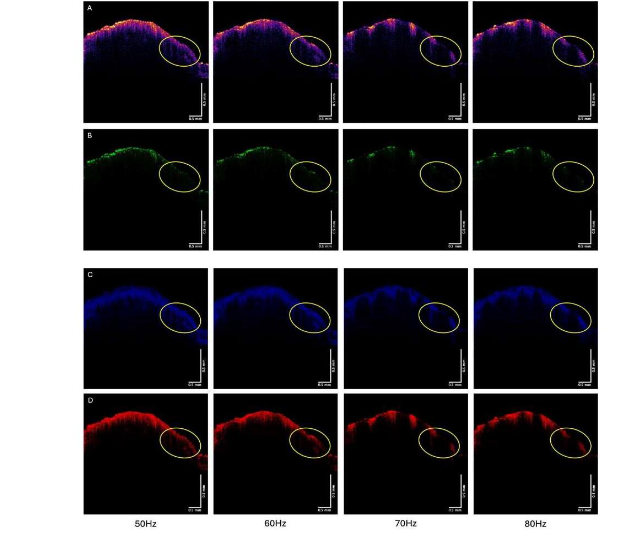 Figure 5 shows the OCT color-coded images of the SCC vibrated at 50, 60, 70, and 80 Hz. Note the cells in the SCC OCT images appear to disappear when vibrated at 70 and 80 Hz.