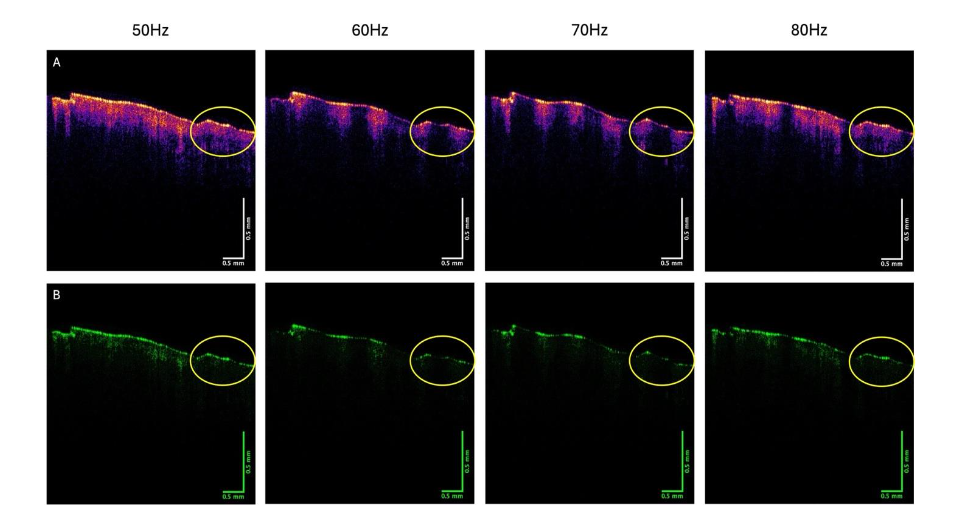 Figure 2. Color-coded OCT images of patient of a nodular BCC (A), the green (B), blue (C), and red (D) subchannels at vibrational frequencies of 50, 60, 70, and 80 Hz. The location of the nodular BCC is circled in each image.