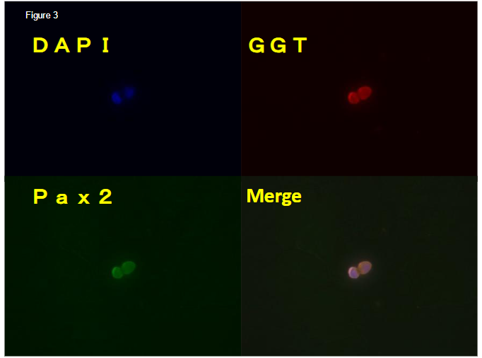 Figure 3: Immunostaining of round cell. Round cell is positive for GGT and Pax2 a marker of epithelial cells and undifferentiated cells respectively.