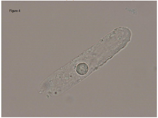Figure 4: Round cell can be found in urinary cast, suggesting that the cell is derived from either glomerulus or tubules but not from ureter or lower urinary tract.
