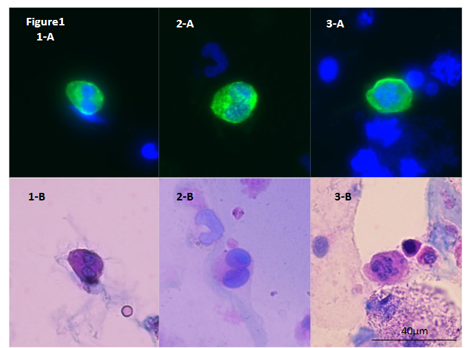 Figure 1: The representative images of urinary podocytes. A: Immunofluorescence staining. B: Sternheimer staining after immunofluorescence staining in the same sample.