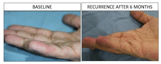Figure 4: Recurrence after 6 months following initial improvement, with reduced baseline iron and ferritin levels due to lack of compliance.