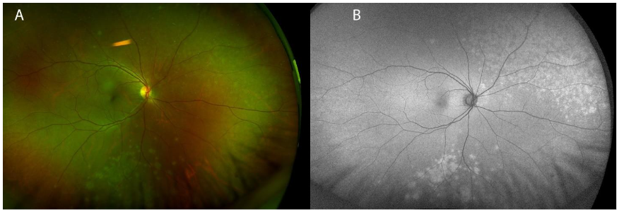 Figure 1A: Color fundus photograph showing multiple gray-white peripheral choroidal lesions of the right eye, inferior and superonasal to the optic disc.