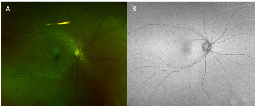 Figure 2: Subsequent exam upon progression of ocular symptoms and headache, prior to treatment, demonstrated increased number of choroidal lesions on color fundus photograph (A) and autofluorescence (B).