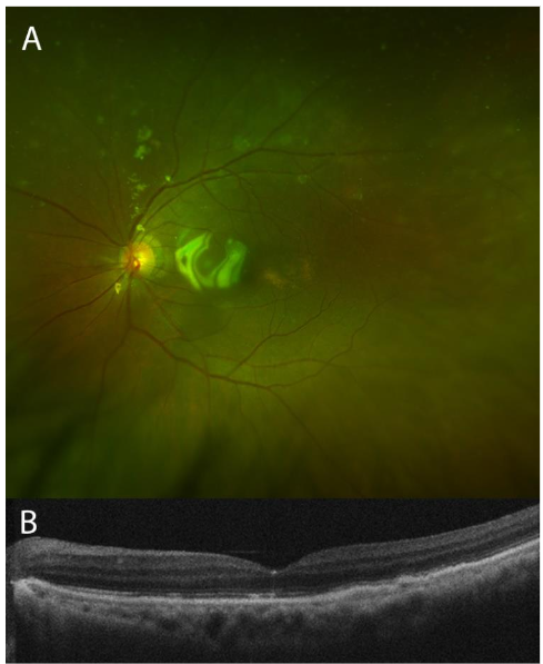 Figure 7: After two weeks of steroids and cycloplegia, color fundus photograph shows an increased number of choroidal lesions and a new rhegmatagenous component to the retinal detachment inferiorly (A), and OCT demonstrates corresponding subretinal and intraretinal fluid (B).