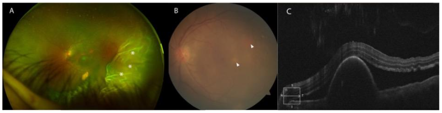 Figure 3: After initiation of treatment, choroidal lesions resolved, as demonstrated on color fundus photograph (A) and autofluorescence (B).