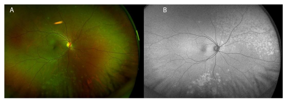 Color fundus photograph showing multiple gray-white peripheral choroidal lesions of the right eye, inferior and superonasal to the optic disc.