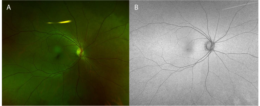 After initiation of treatment, choroidal lesions resolved.