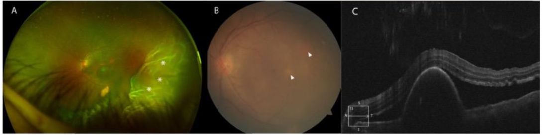 Color fundus photographs of the left eye with vitreous haze, a temporal exudative retinal detachment, and new gray-white choroidal lesions.