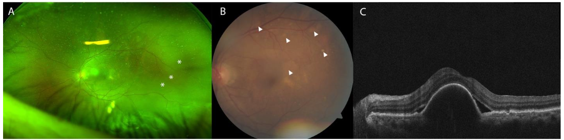After initiation of oral and topical steroids, exudative retinal detachment improved, but macular choroidal lesions increased in number and size.